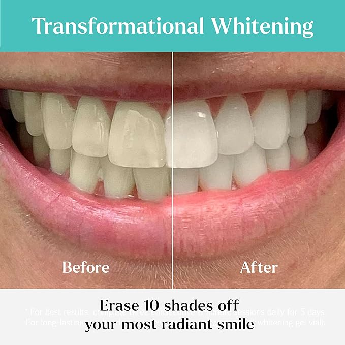 GLO Science So Brilliant Teeth Whitening Kit – Patented Warming Mouthpiece with LED Light Technology, Whitening Gel w/ 6% Hydrogen Peroxide, Lip Balm – Fastest Way to Whiter Teeth, Sensitivity Free-HomvellaHome